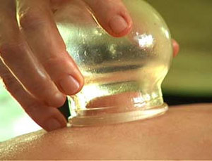 Cupping acupuncture technique on human back