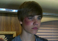 Justin Bieber gets beat up and receives a black eye