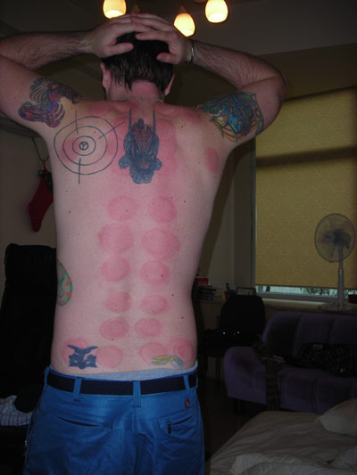 Casey Freeman's back with acupuncture suction cup red marks