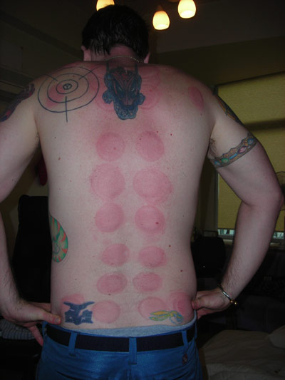 KC shows off his back with suction cup red marks