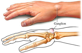 Ganglion cyst on hand diagram