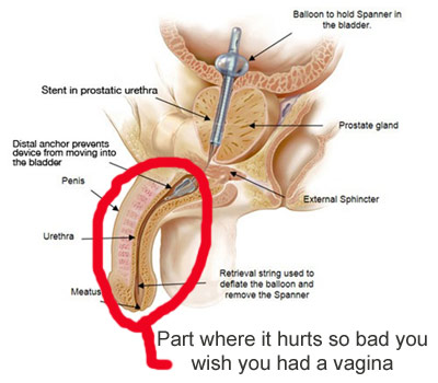 Stent removal through penis hurts a lot