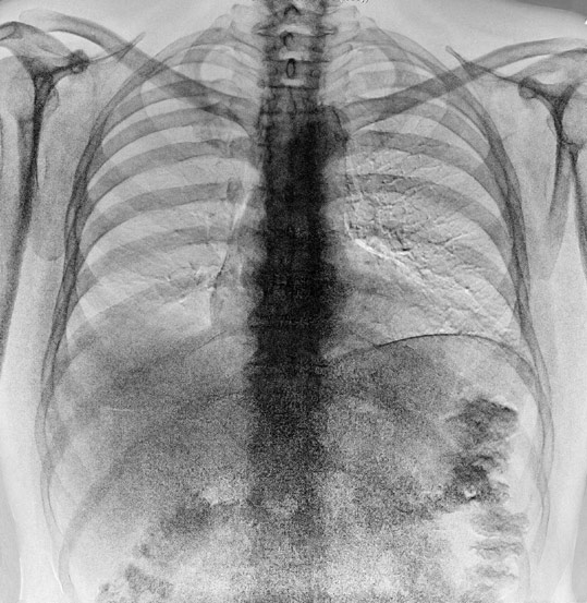 Atrophying rib cage X-ray