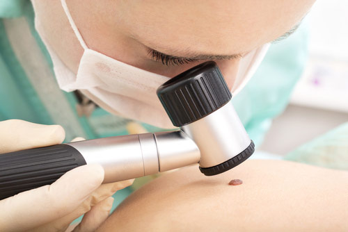 Doctor inspects a mole on a patient's back