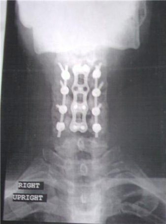 Spinal pins in the neck