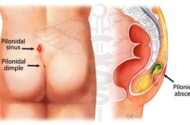 Pilonidal cyst diagram