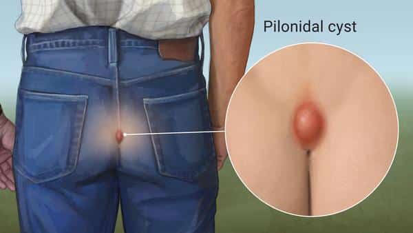 Diagram of Pilonidal cyst above coccyx region (butt)