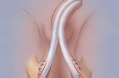 Stent inserted into penis