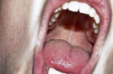 Open mouth with thrush and bad breath